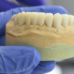 Dentures vs Dental Implants