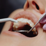 Gum Disease Treatment