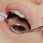 Tooth Gap Treatment