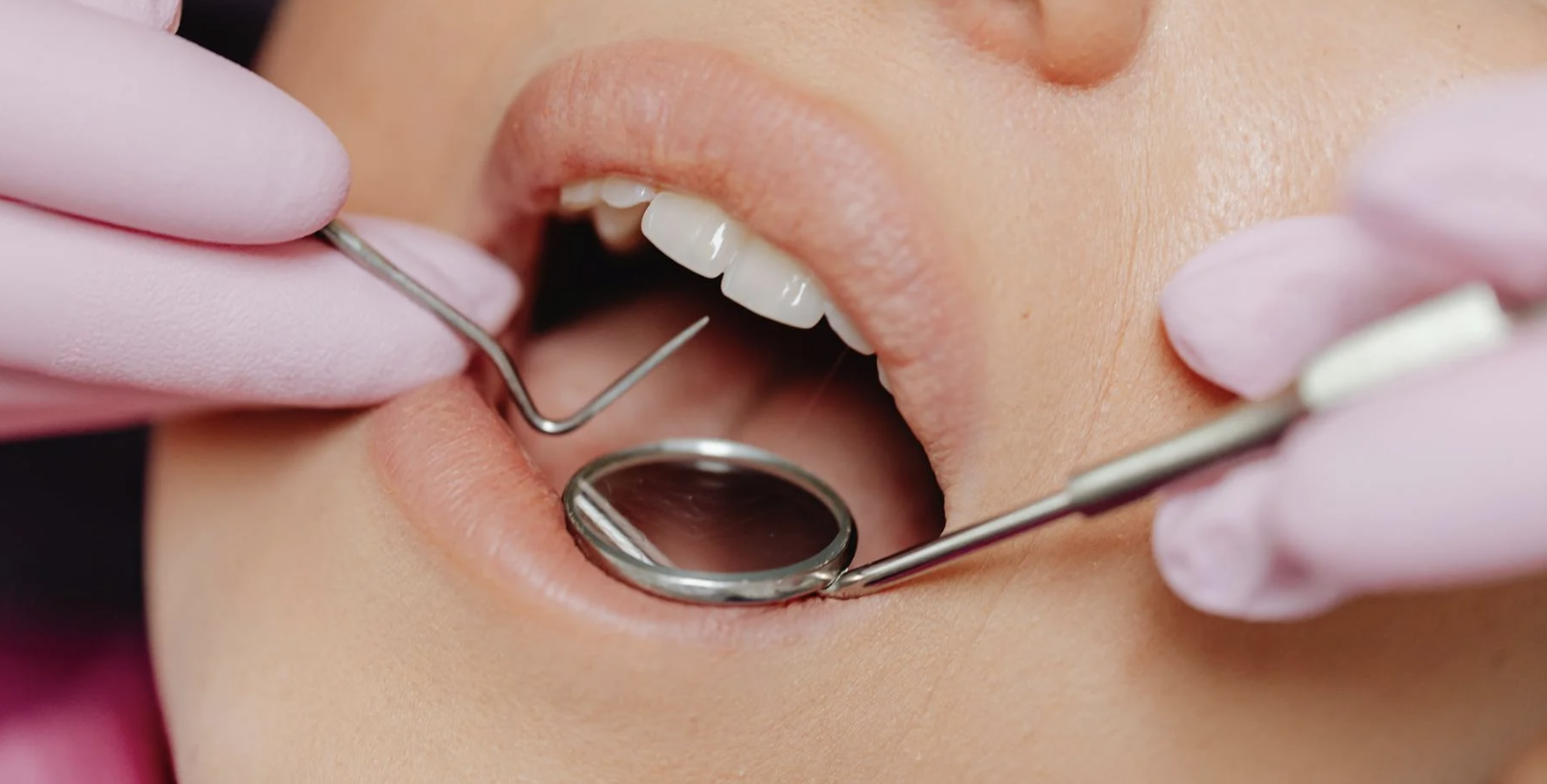 Tooth Gap Treatment