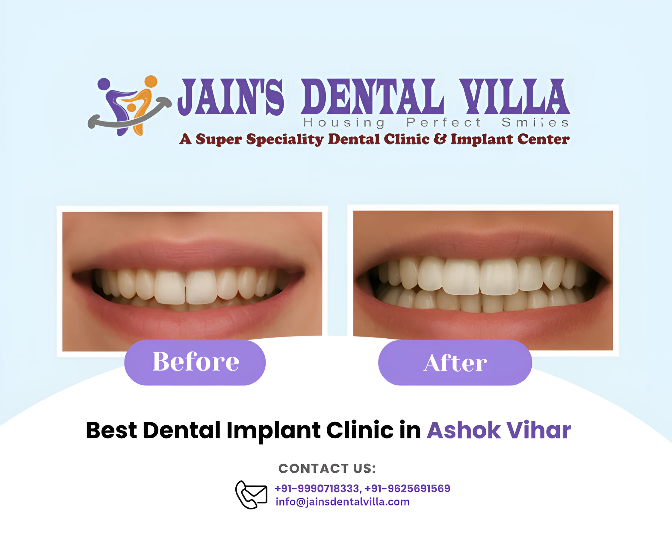 dental implants in ashok vihar