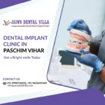 dental implants clinic in paschim vihar