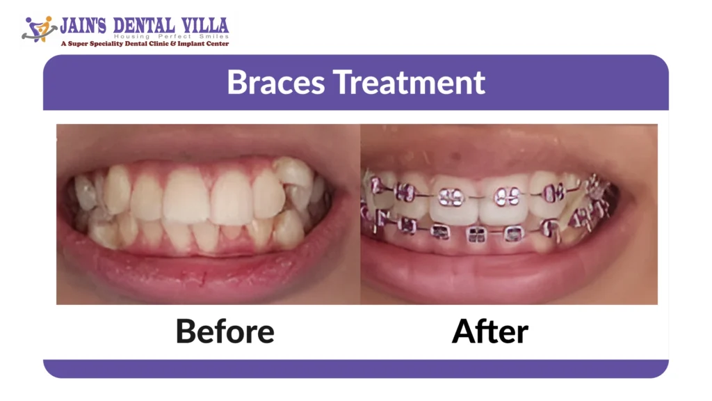 Braces treatment Before and after