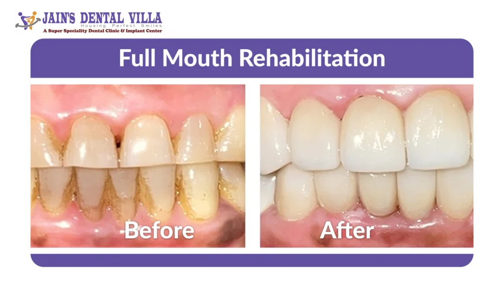 before and after full mouth rehabilitation