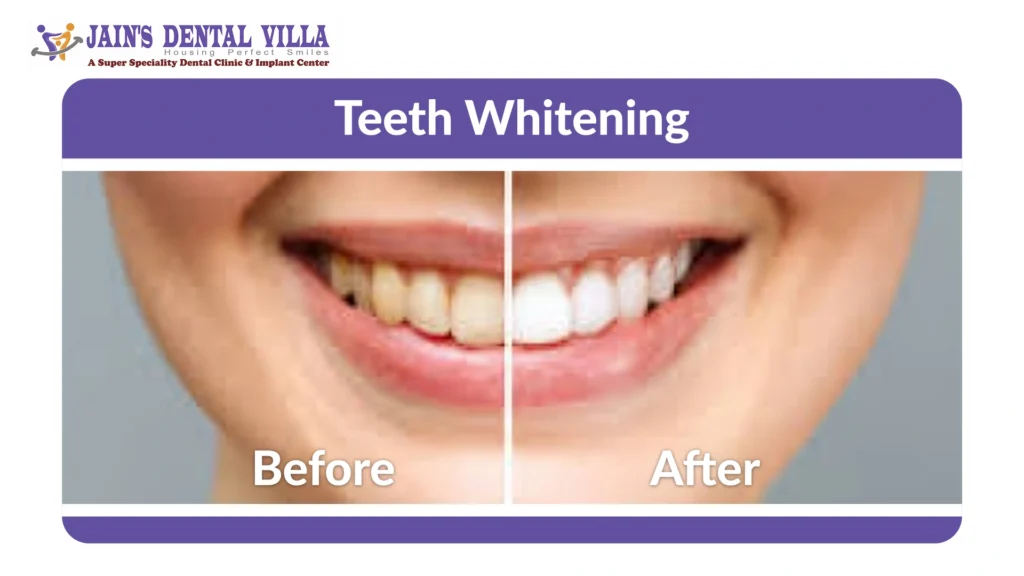 Teeth whitening before and after