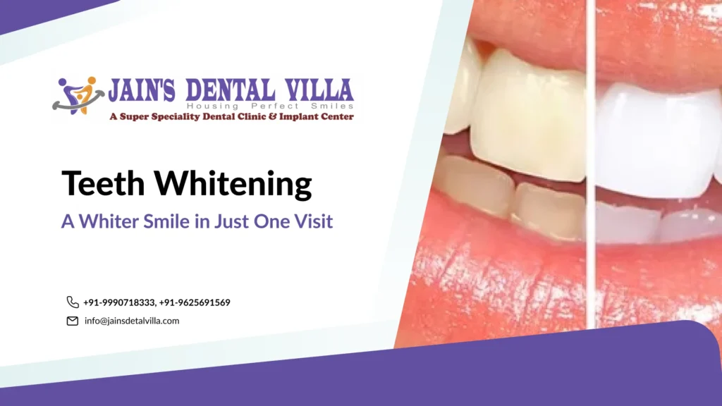 Teeth whitening1
