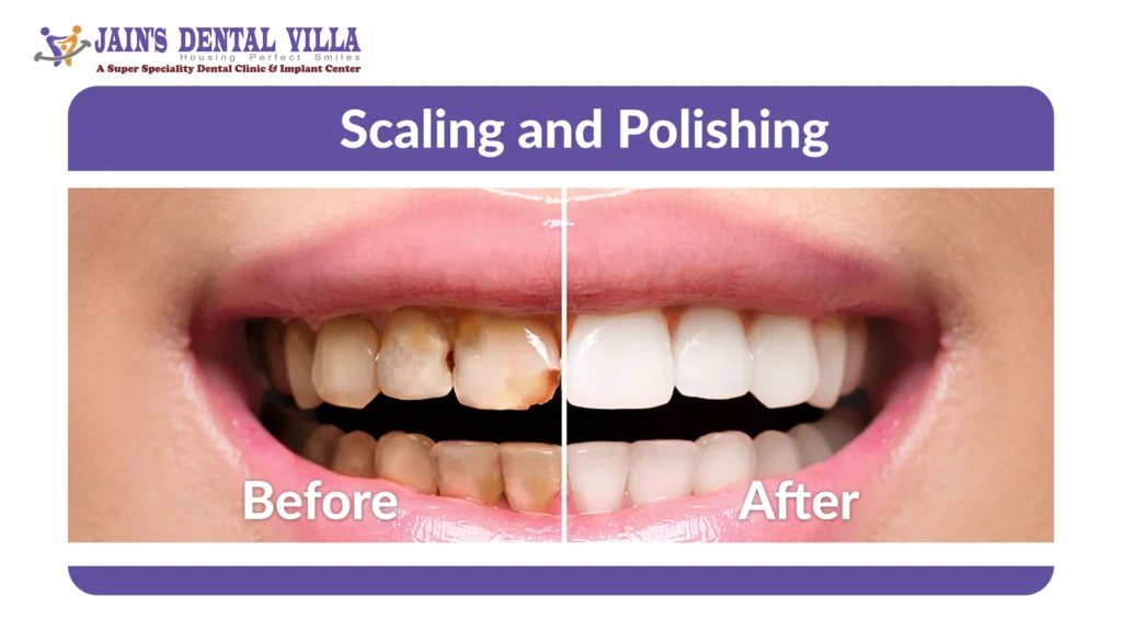 Before and After Teeth Cleaning