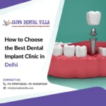 best dental implant clinic in delhi