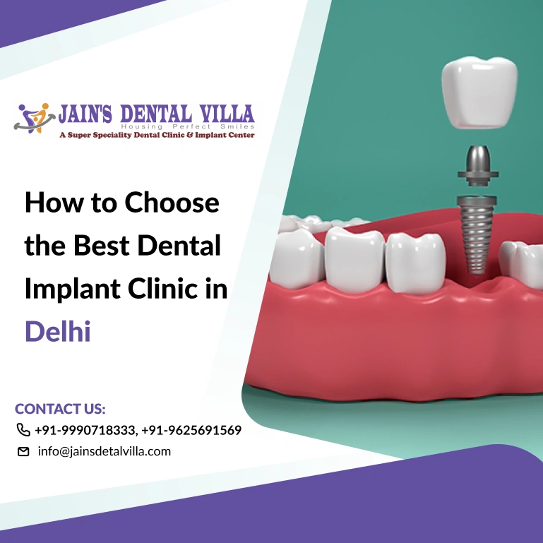 best dental implant clinic in delhi