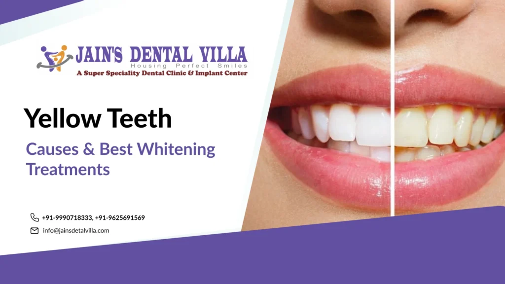 Yellow Teeth Causes & Best Whitening Treatments