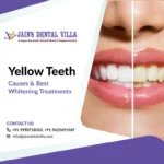 Yellow Teeth Causes & Best Whitening Treatments by jains dental villa