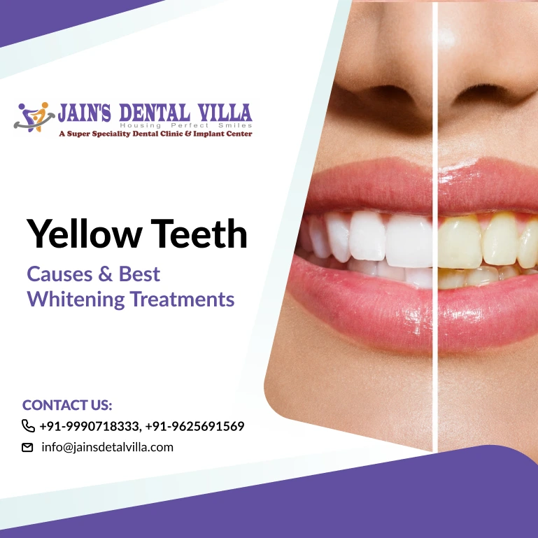 Yellow Teeth Causes & Best Whitening Treatments by jains dental villa